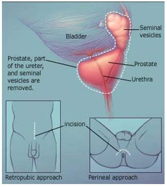 Chirurgie ouverte du cancer de la prostate