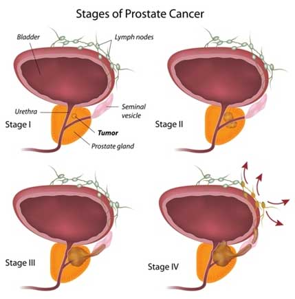 Open Prostate Cancer Surgery