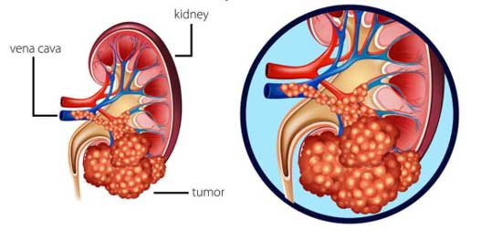 Kidney Cancer