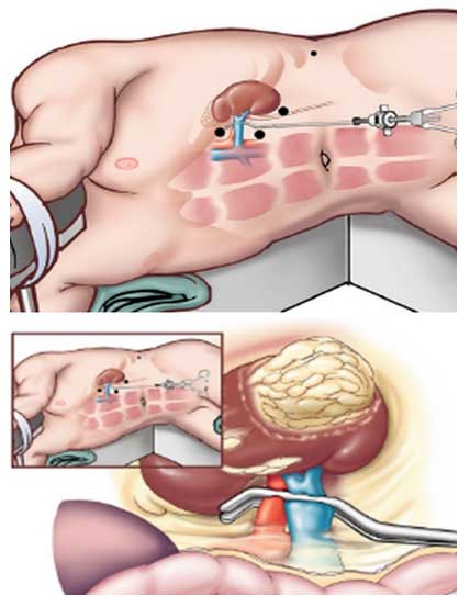 Cancro ai reni