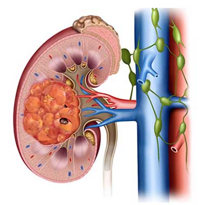 Böbrek Kanseri