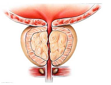 Chirurgie endoscopique de la prostate TUR-P