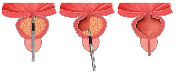 Chirurgie endoscopique de la prostate TURP
