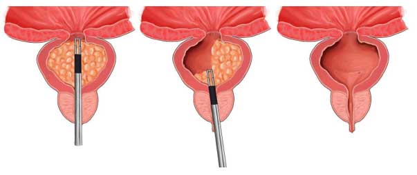 Endoskopische Prostatachirurgie TURP