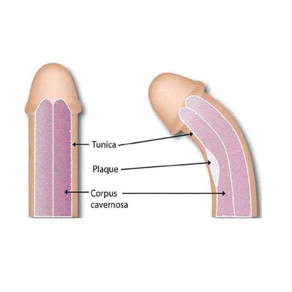 Penis Eğriliği Cerrahisi