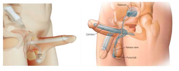 Inflatable Penile Prosthesis