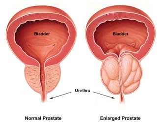 Trattamento laser della prostata